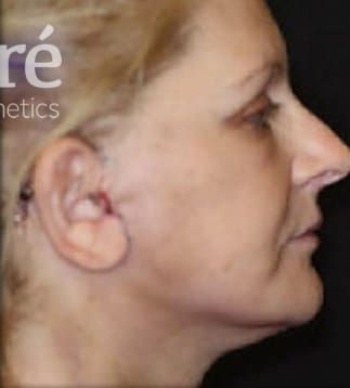 Facelift Before & After