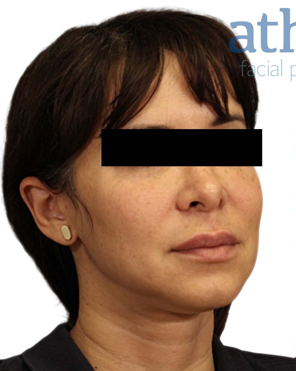 Facelift Before & After
