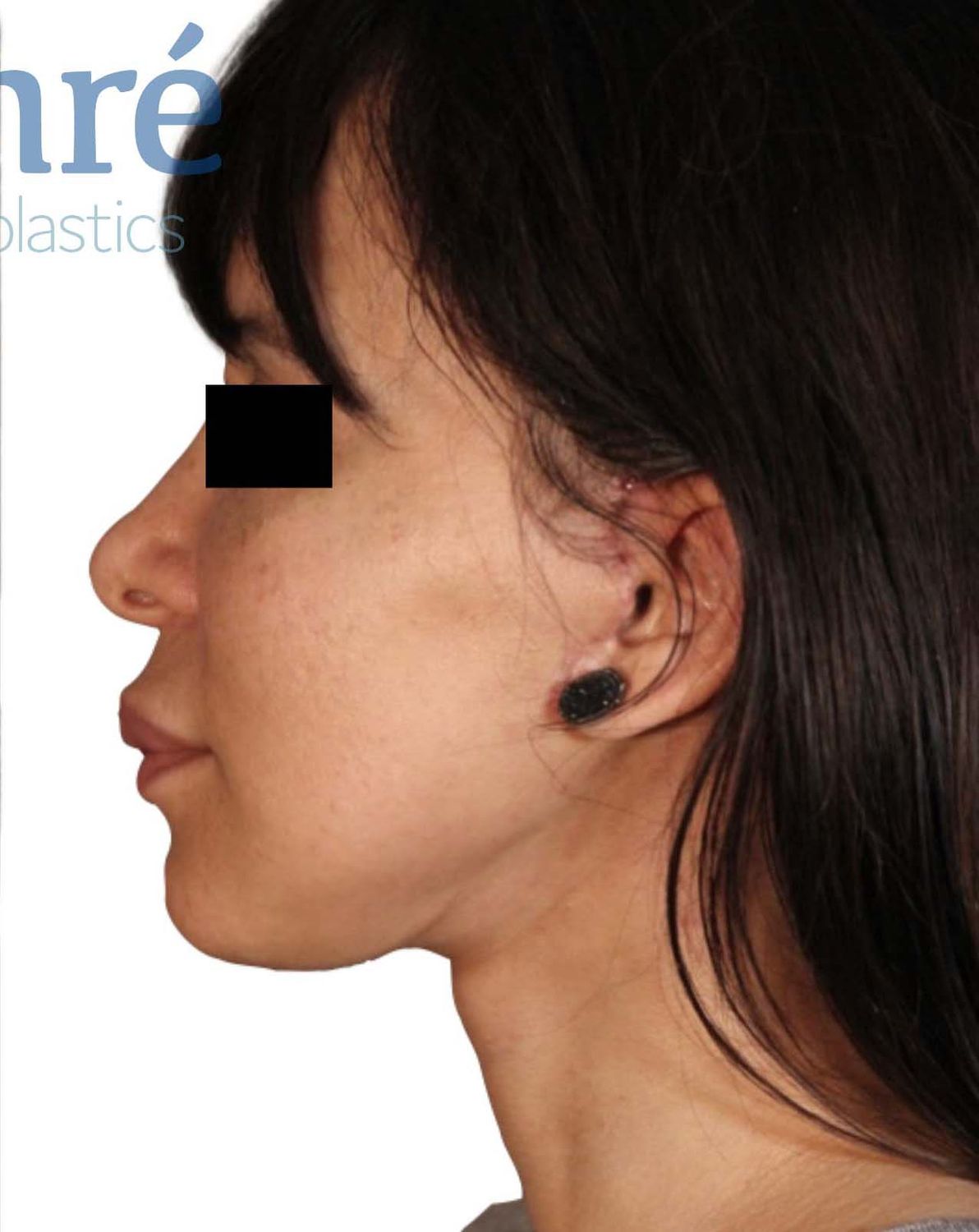 Facelift Before & After