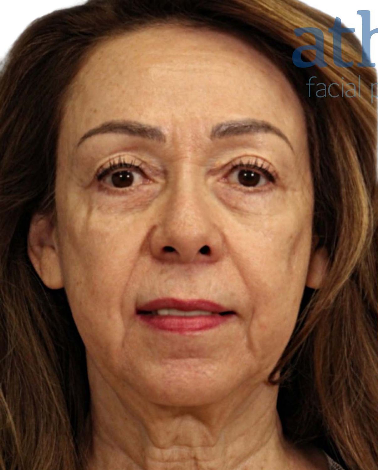 Facelift Before & After