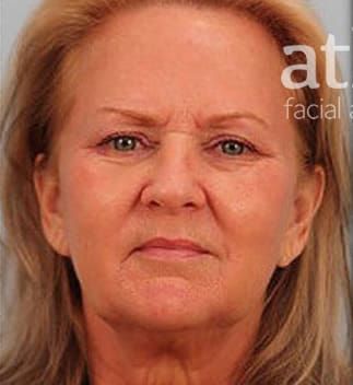 Facelift Before & After
