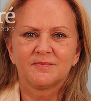 Facelift Before & After