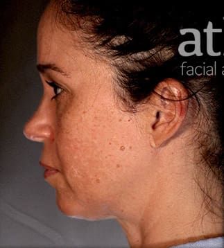 Facelift Before & After