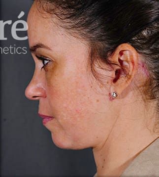 Facelift Before & After