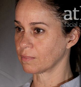 Facelift Before & After