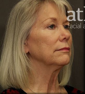 Facelift Before & After