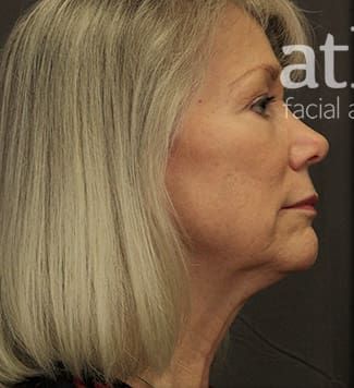 Facelift Before & After