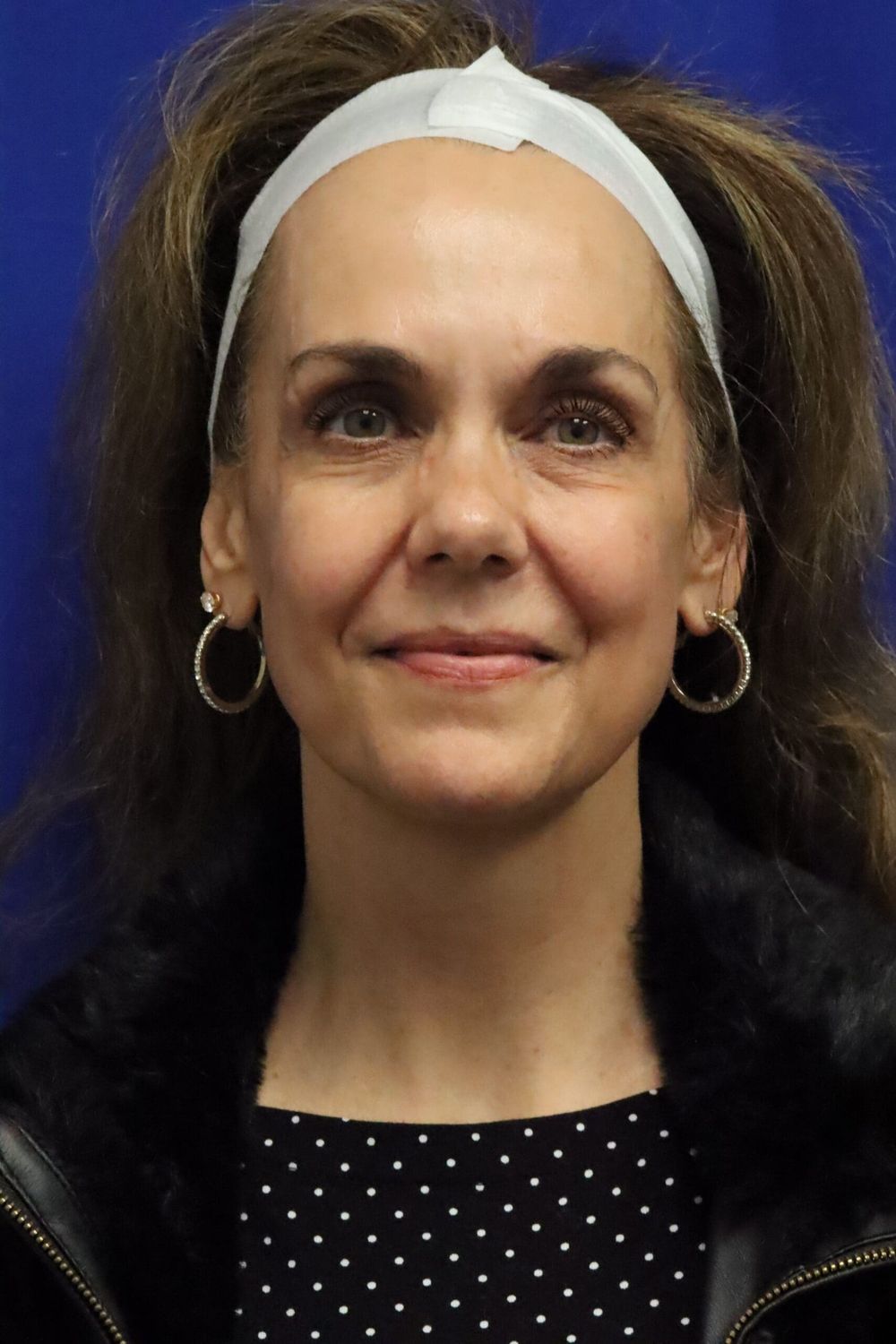 Facelift Before & After