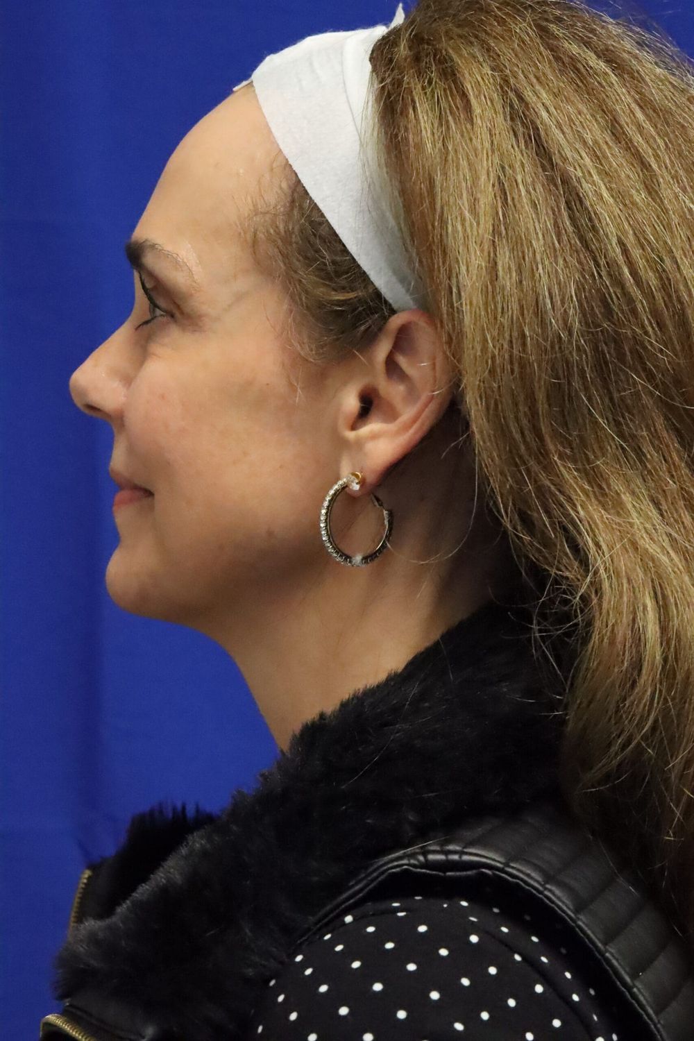 Facelift Before & After