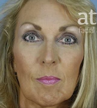 Facelift Before & After
