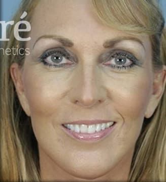 Facelift Before & After