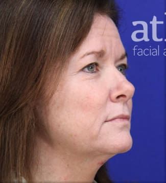 Facelift Before & After