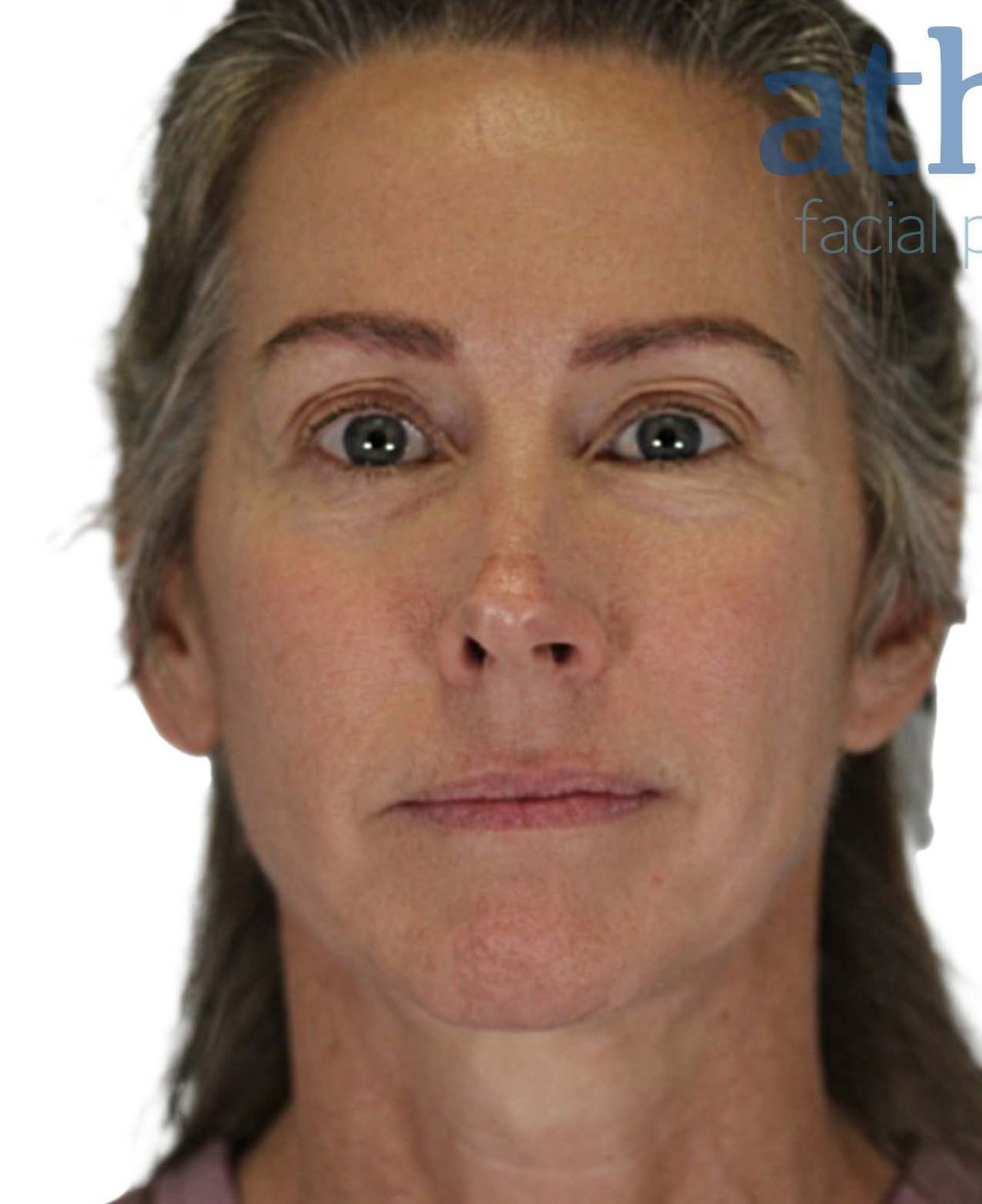 Facelift Before & After