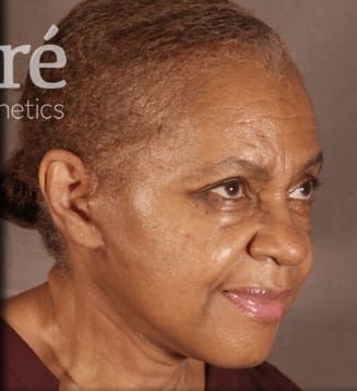 Facelift Before & After