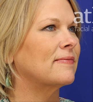 Facelift Before & After