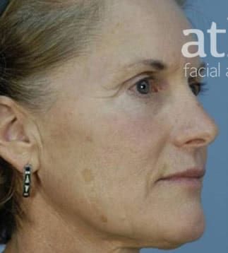 Facelift Before & After
