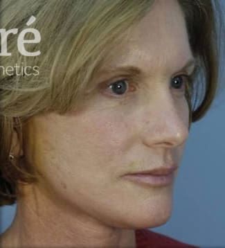 Facelift Before & After