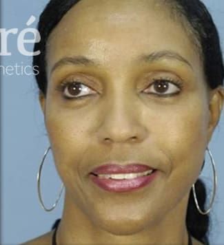 Facelift Before & After