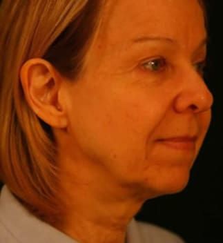 Facelift Before & After