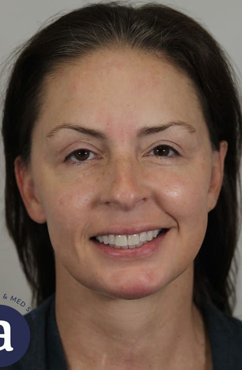 Facelift Before & After