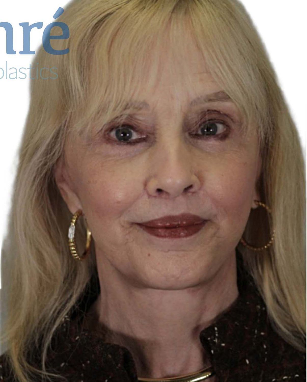 Facelift Before & After