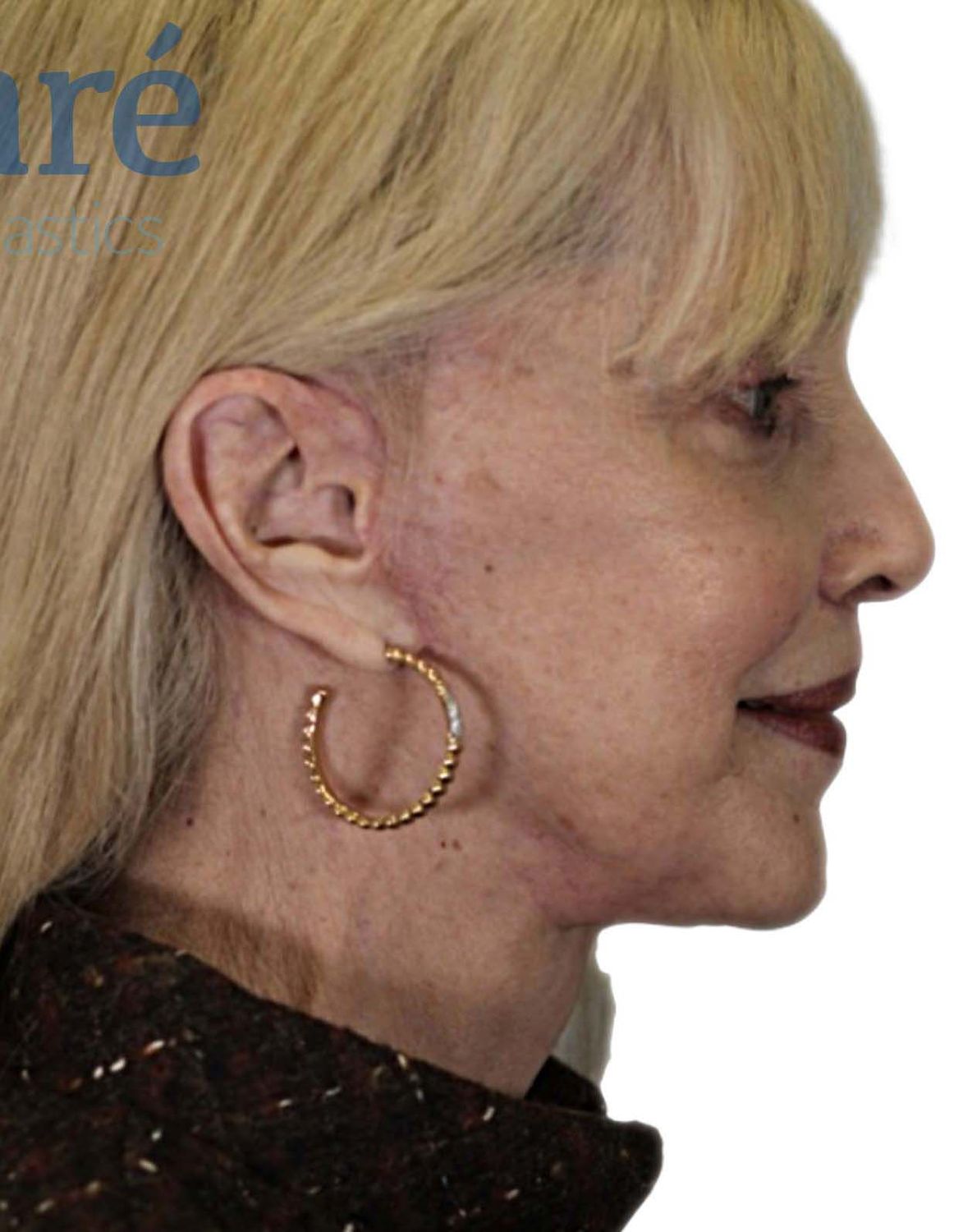 Facelift Before & After