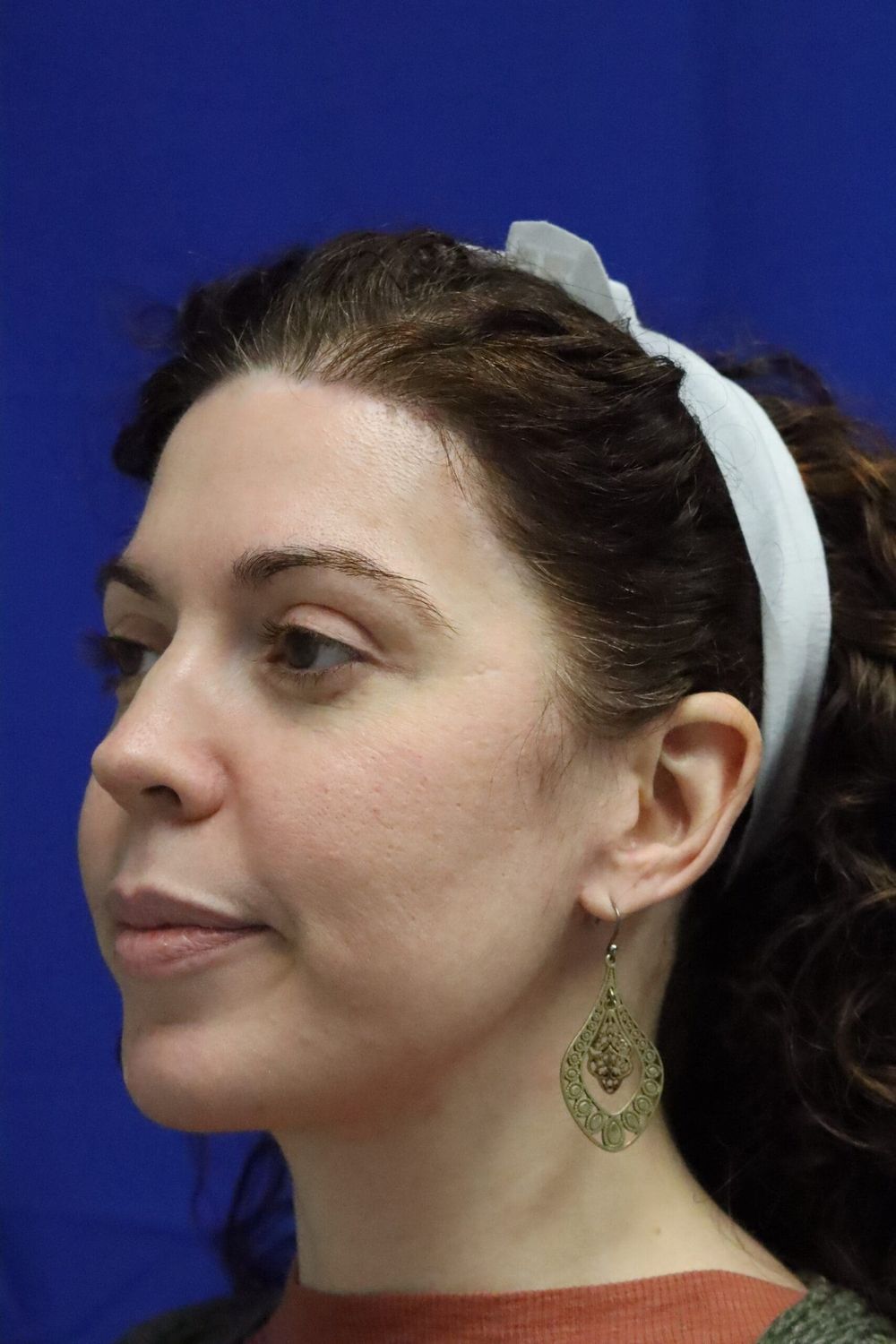 Facelift Before & After