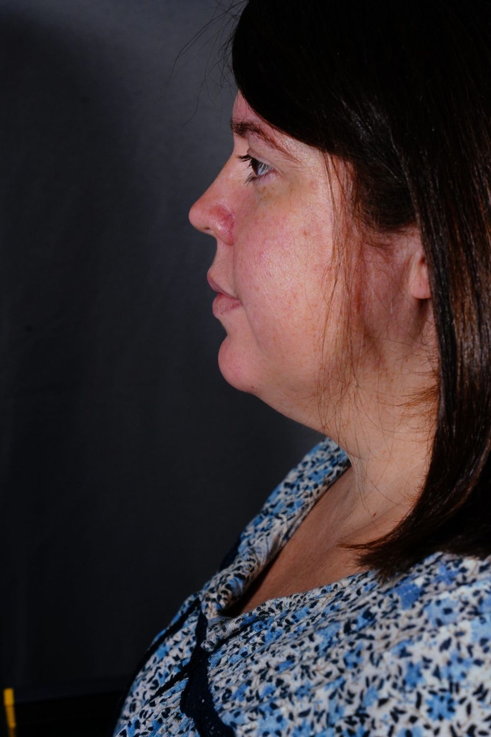 Facelift Before & After