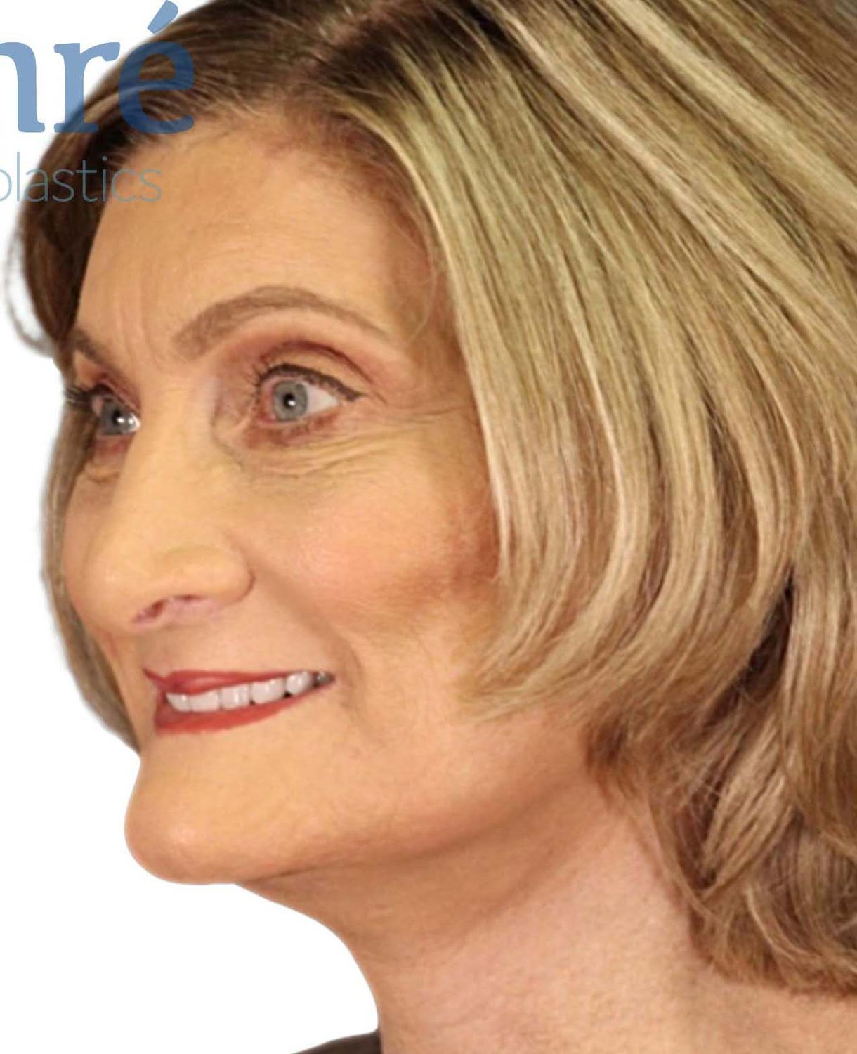 Facelift Before & After