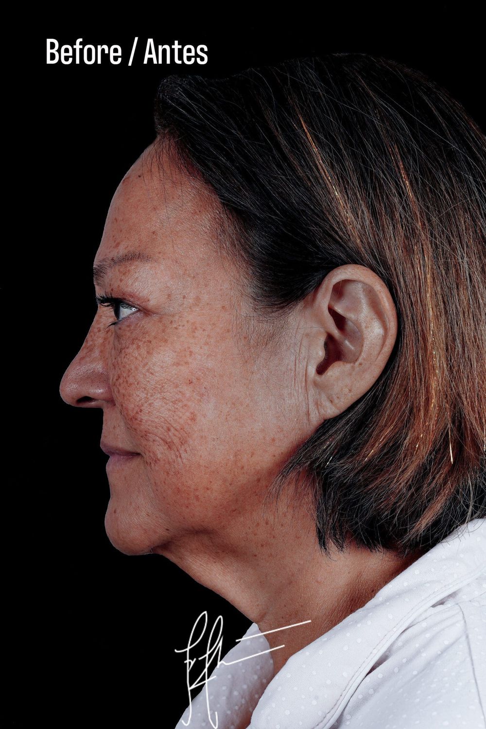 Facelift Before & After