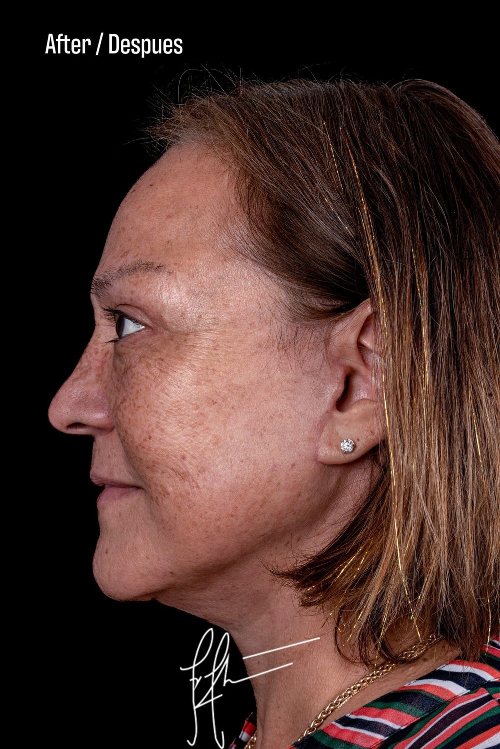 Facelift Before & After