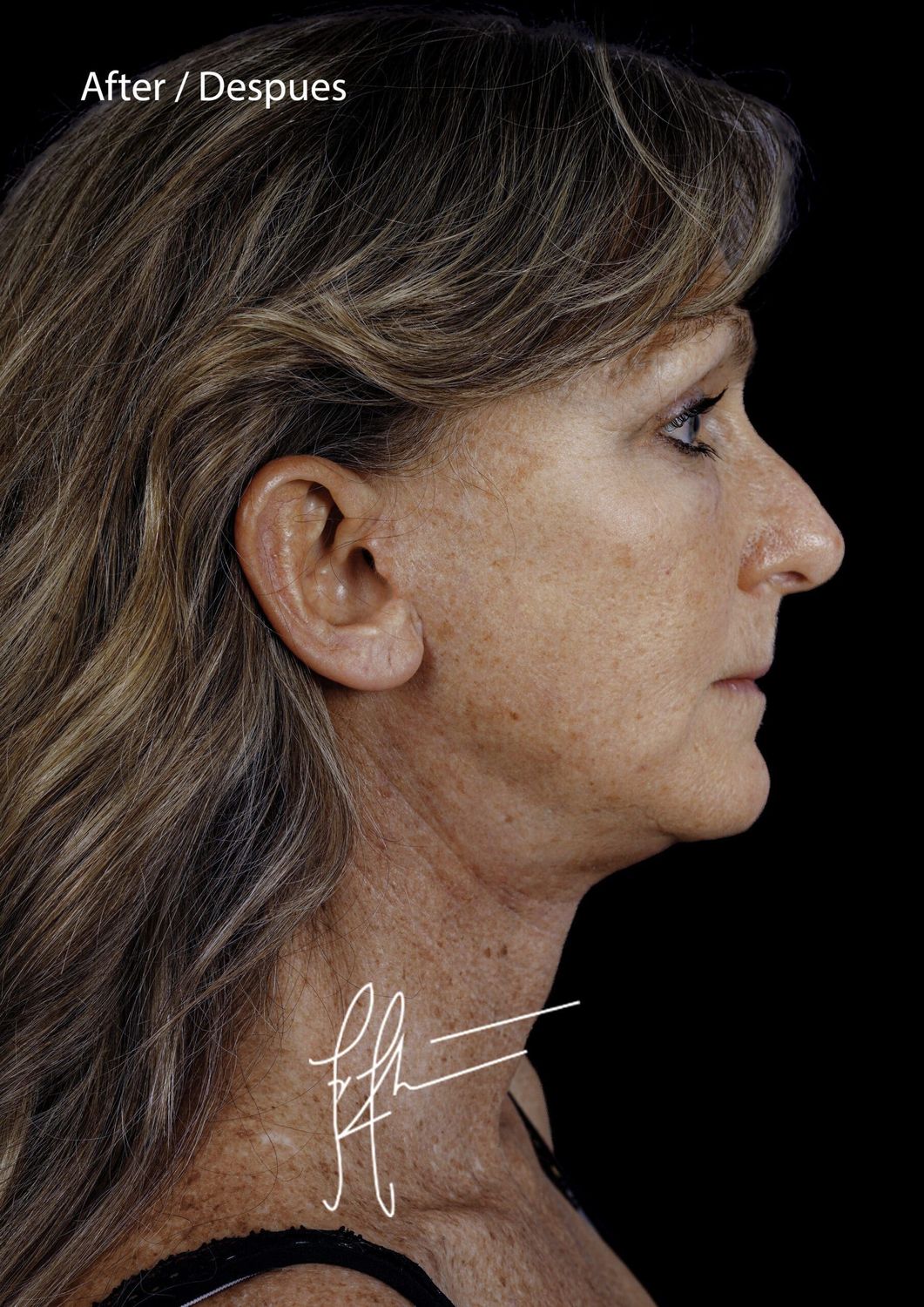 Facelift Before & After