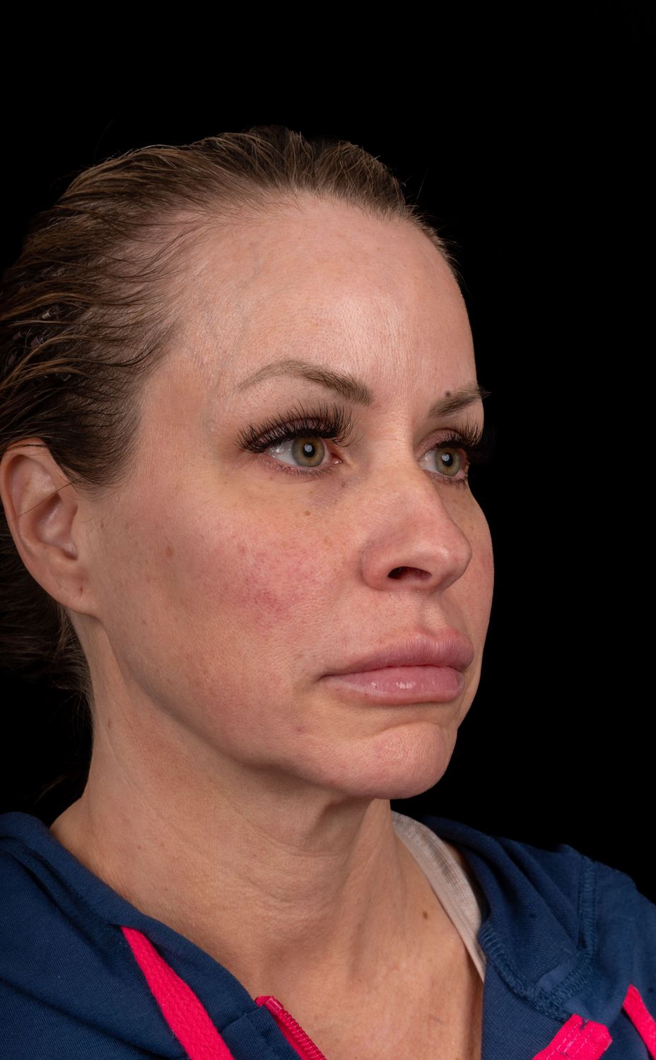 Facelift Before & After