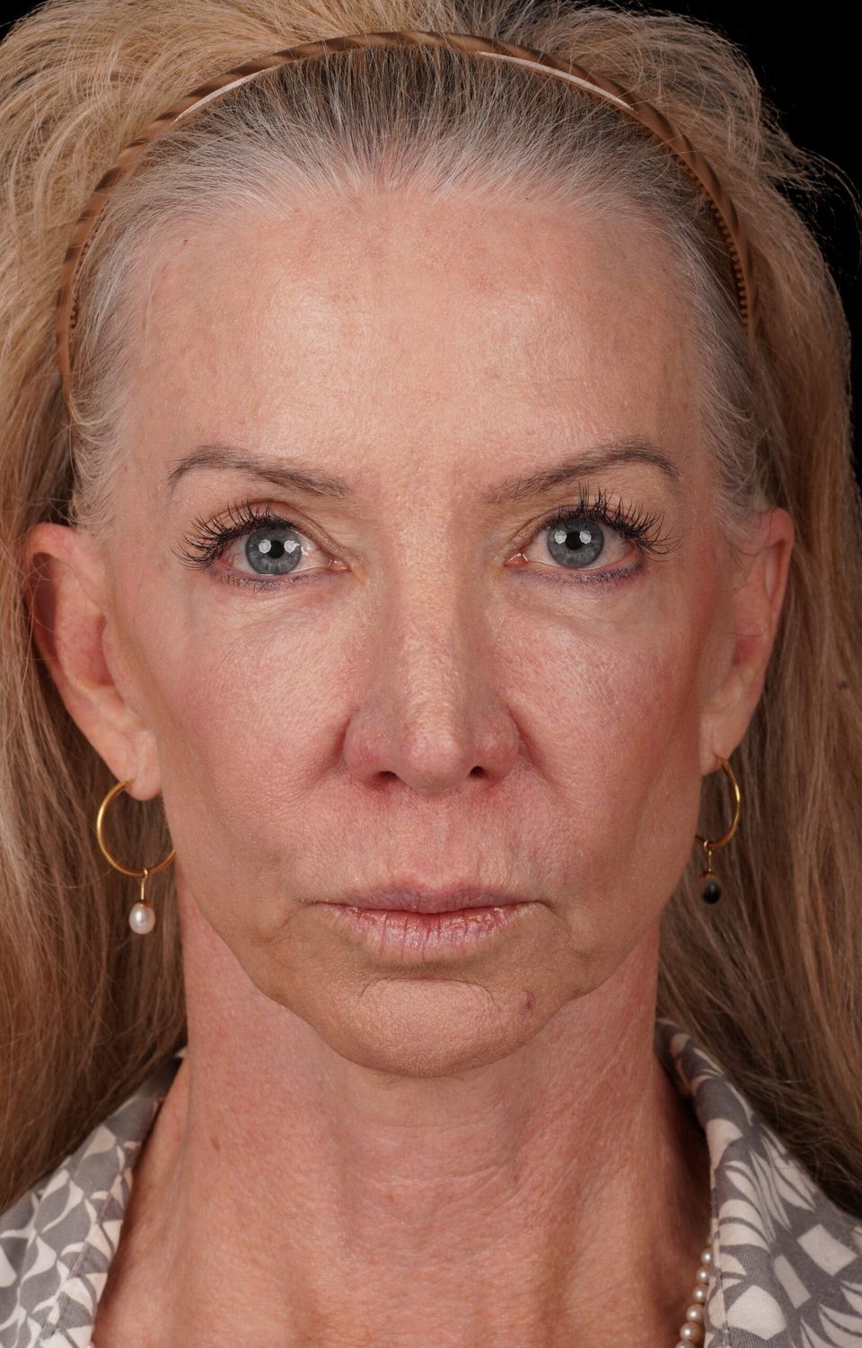 Facelift Before & After