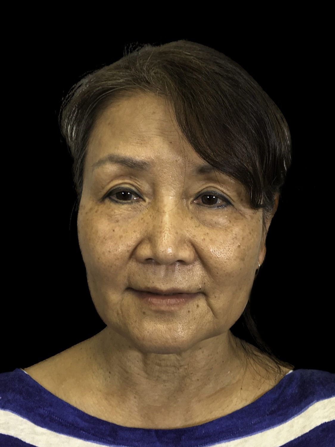 Facelift Before & After