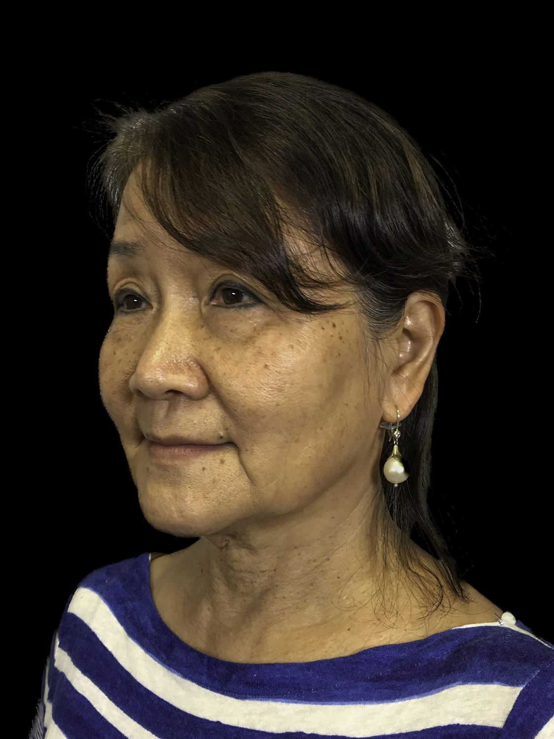 Facelift Before & After