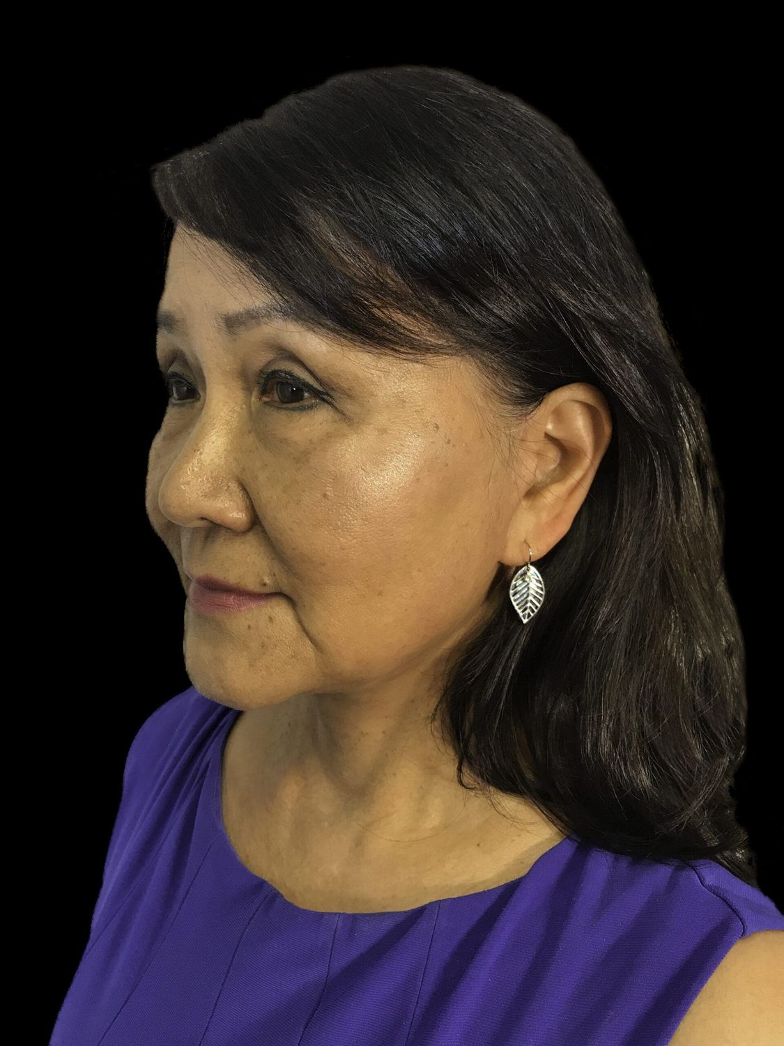 Facelift Before & After