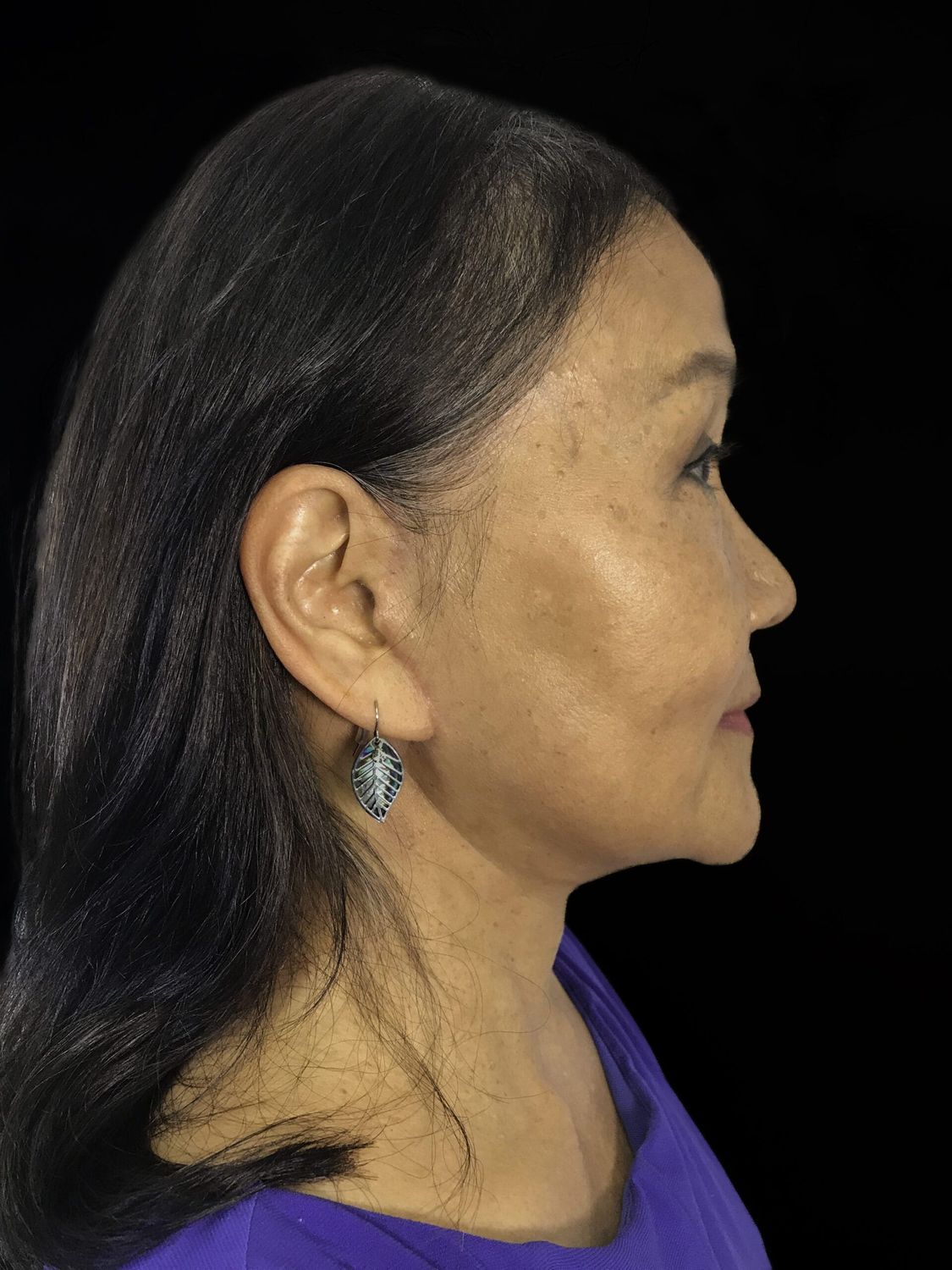 Facelift Before & After