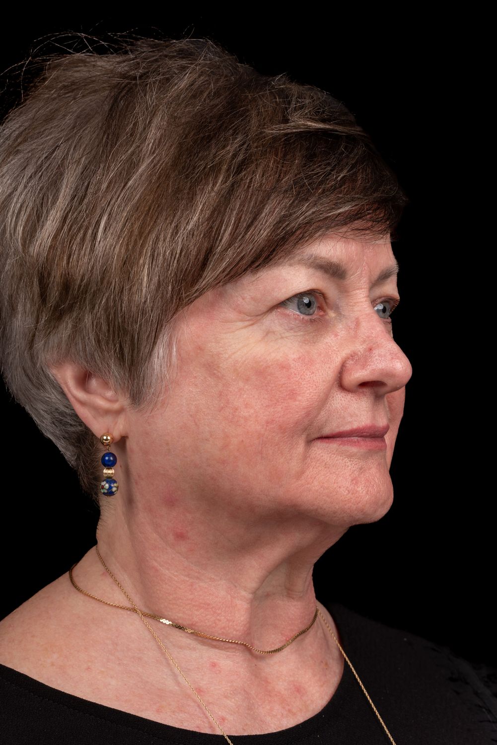 Facelift Before & After