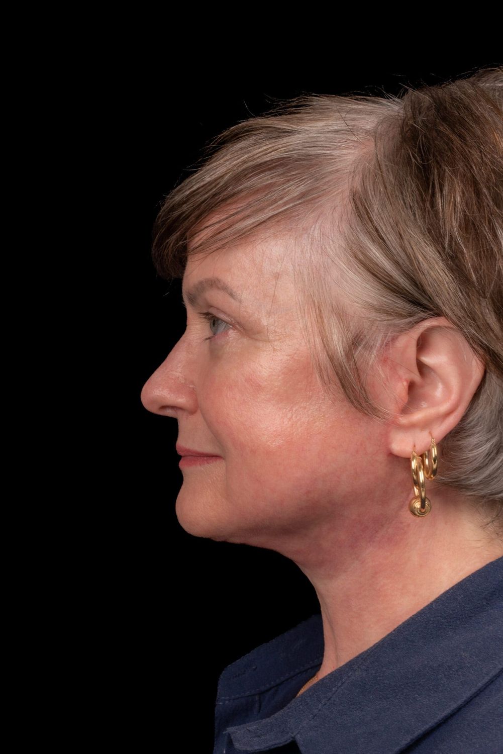 Facelift Before & After