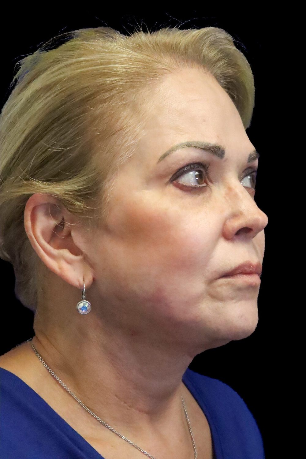 Facelift Before & After