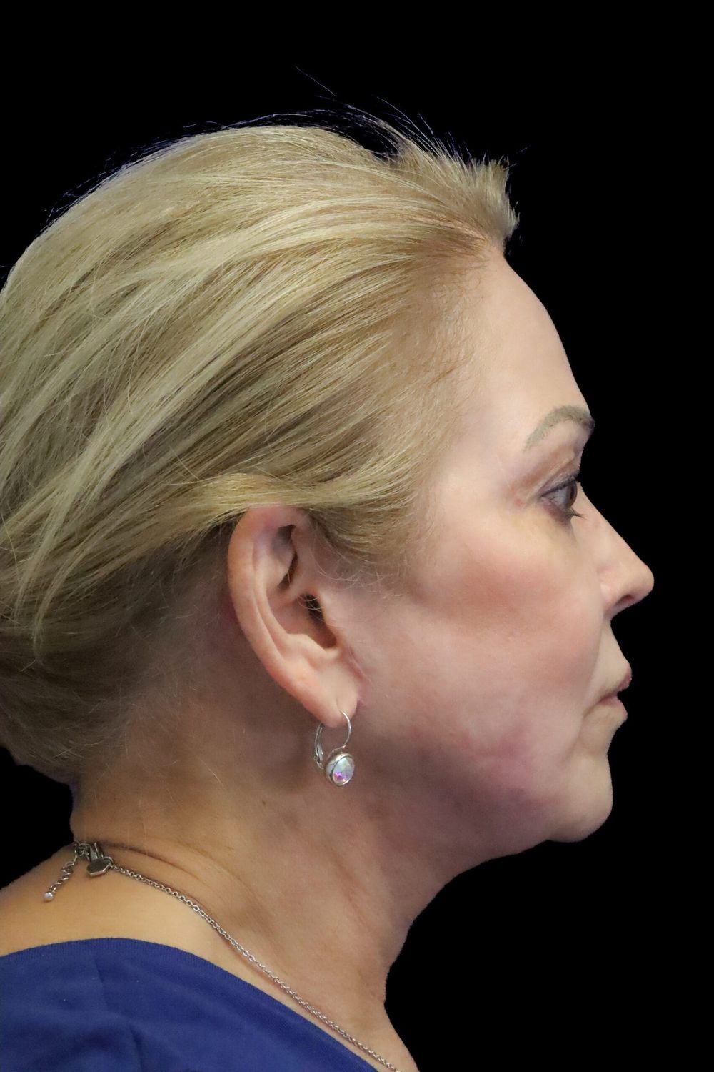 Facelift Before & After