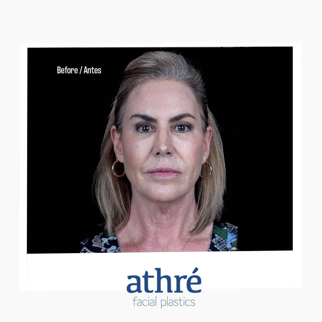 Facelift Before & After