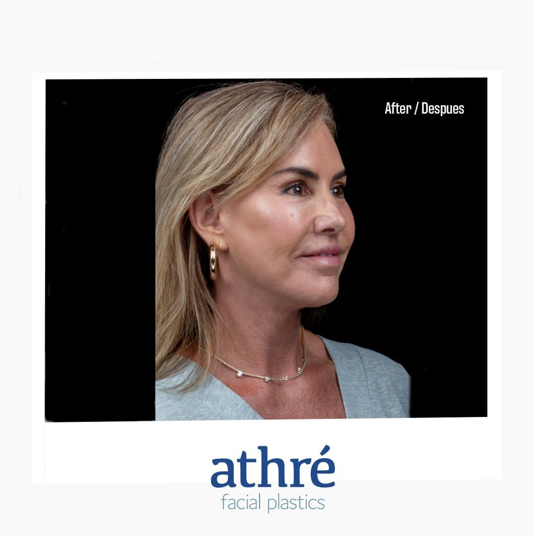 Facelift Before & After