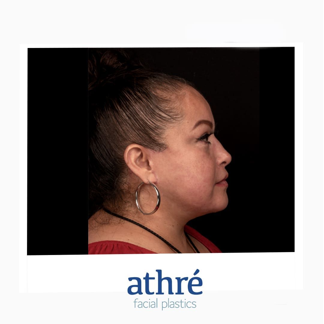 Facelift Before & After