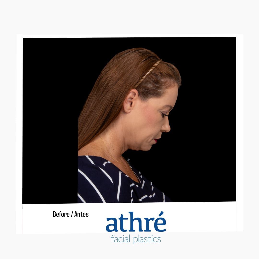 Facelift Before & After