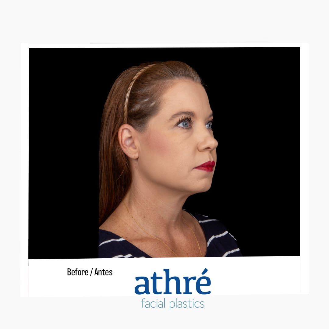 Facelift Before & After