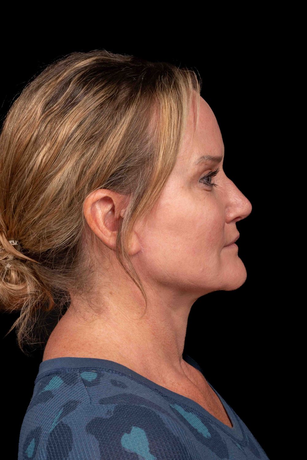 Facelift Before & After