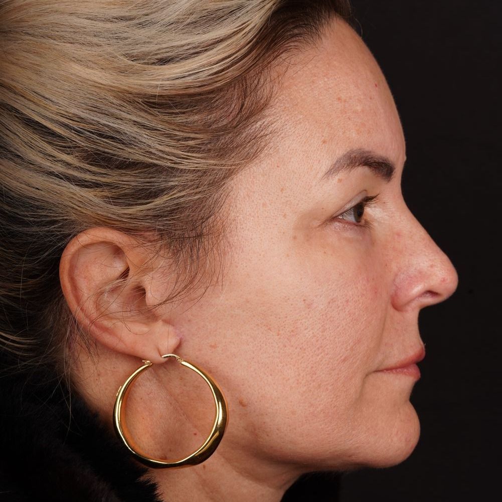 Facelift Before & After