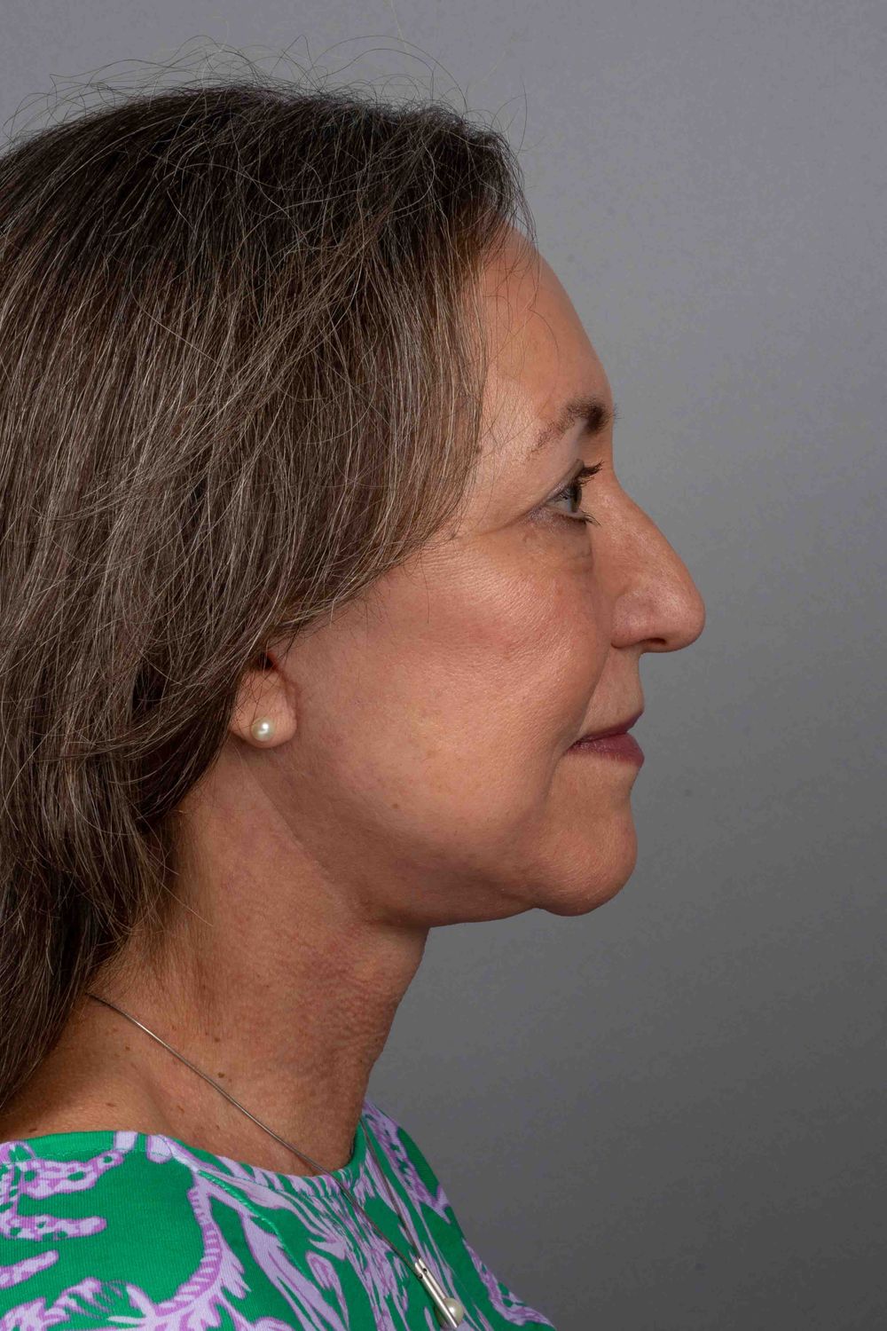 Facelift Before & After